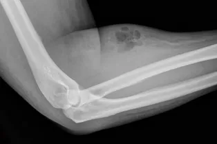 Мужчина полтора года вводил сперму себе в вены