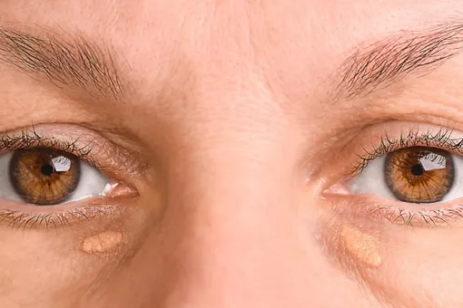 признаки высокого холестерина