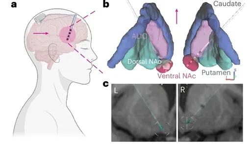 а) Два четырехполярных глубинных электрода были размещены с обеих сторон в вентральной части NAc участника с нейростимулятором, полностью имплантированным подкожно в череп. b, Анатомическая схема (вид сзади). c, Анатомическая магнитно-резонансная томография участника.