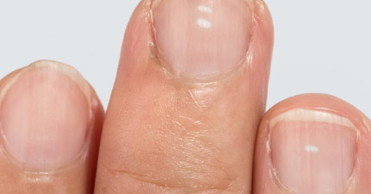Маленькие белые пятна на ногтях: что это такое?
