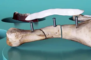 Быстро, удобно, надежно: как ученые разработали уникальный пластырь для сращивания костей Быстро, удобно, надежно: как ученые разработали уникальный пластырь для сращивания костей