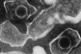 Ученые связывают волчанку с вирусом, который есть у 95% людей Ученые связывают волчанку с вирусом, который есть у 95% людей