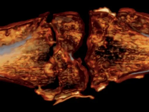 Компьютерная томография колена Тутанхамона между тем показывает сильную травму, которая, вероятно, привела к его смерти / Компьютерная томография колена Тутанхамона между тем показывает сильную травму, которая, вероятно, привела к его смерти /