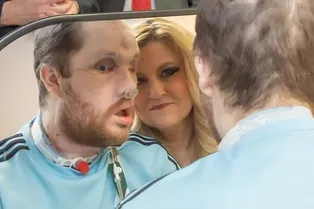 Мужчине пересадили лицо после попытки самоубийства, чтобы он начал новую жизнь