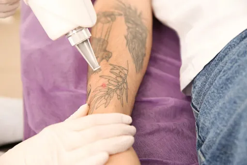 Лазерное удаление тату Лазерное удаление тату