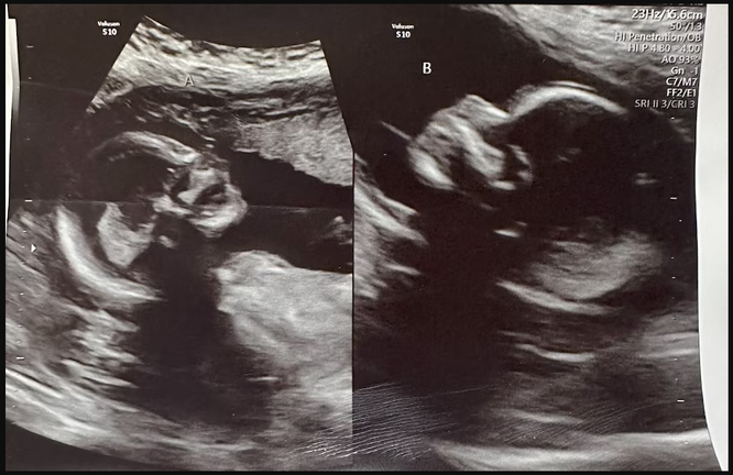 Двойная матка