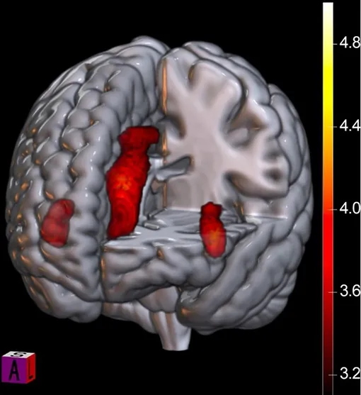 Отображение негативного эффекта поражения от принципиального соперника. Сеть значимости деактивируется. Цветовая шкала представляет значения активности (Z). Более теплые цвета обозначают более высокое положительное значение Z, более холодные цвета обозначают отрицательную/относительную деактивацию). A = передний, L = левый, S = верхний. Отображение негативного эффекта поражения от принципиального соперника. Сеть значимости деактивируется. Цветовая шкала представляет значения активности (Z). Более теплые цвета обозначают более высокое положительное значение Z, более холодные цвета обозначают отрицательную/относительную деактивацию). A = передний, L = левый, S = верхний.