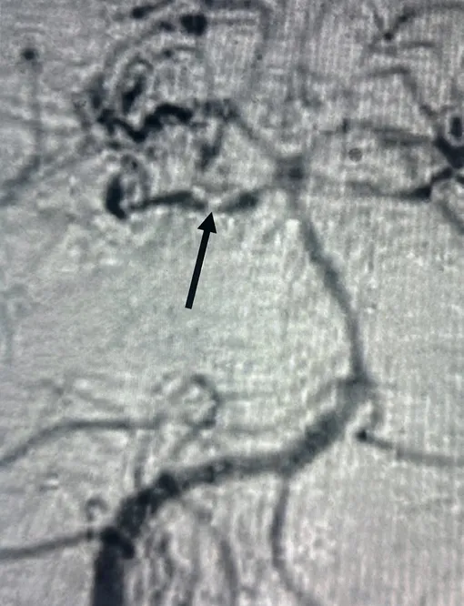 МРТ мужчины выявила тромб, который стал причиной инсульта. /