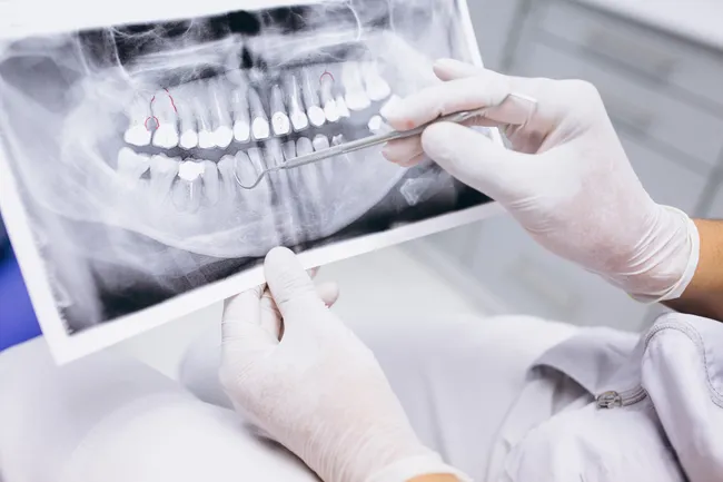 стоматологический снимок челюсти стоматологический снимок челюсти