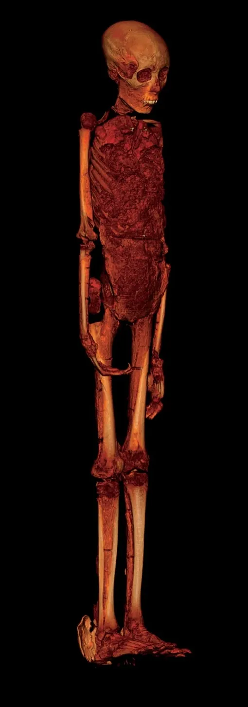 Компьютерная томография показывает деформированную ступню, сломанное колено, торчащие зубы и удлиненный череп Тутанхамона / Компьютерная томография показывает деформированную ступню, сломанное колено, торчащие зубы и удлиненный череп Тутанхамона /