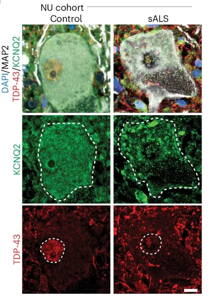 Иммуногистохимия нейронов из неневрологического контроля ( n = 3) и спорадического БАС (сАБС) ( n = 3) срезы спинного мозга, окрашенные на DAPI (синий), MAP2 (белый), KCNQ2 (зеленый) и TDP-43 (красный). Иммуногистохимия нейронов из неневрологического контроля и спорадического БАС срезы спинного мозга
