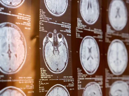 МРТ головного мозга