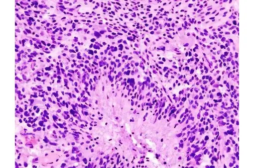 Глиобластома (гистологический слайд)