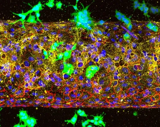 Трехмерная модель опухолевого сосуда на чипе, показывающая клетки рака поджелудочной железы (зеленый цвет), проникающие в искусственный кровеносный сосуд (красный цвет) путем разрушения базальной мембраны сосуда (желтый цвет). Трехмерная модель опухолевого сосуда на чипе, показывающая клетки рака поджелудочной железы (зеленый цвет), проникающие в искусственный кровеносный сосуд (красный цвет) путем разрушения базальной мембраны сосуда (желтый цвет).