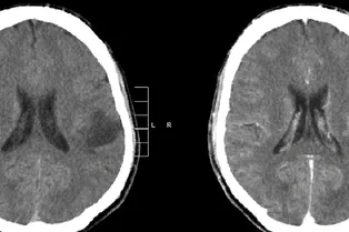 Опухоли могут перепрограммировать мозг — это невероятно страшно и странно Опухоли могут перепрограммировать мозг — это невероятно страшно и странно
