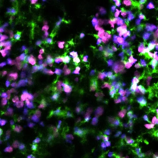 Наблюдение гибели раковых клеток в доклинической модели с использованием двухфотонной визуализации in vivo. Маджента — живые раковые клетки; синий — умирающие раковые клетки; зеленый — макрофаги. I