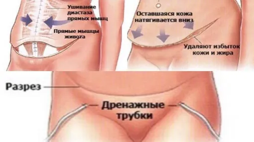 Вот как схематично происходит абдоминопластика Схема абдоминопластики
