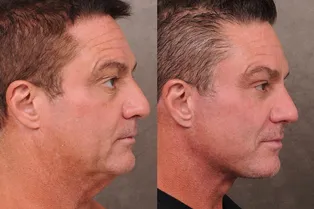 Американские айтишники активно делают подтяжку лица — ради карьеры Американские айтишники активно делают подтяжку лица — ради карьеры