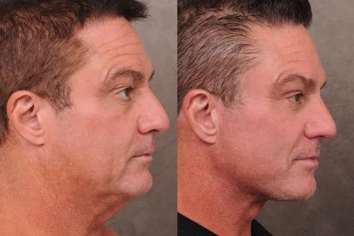 Американские айтишники активно делают подтяжку лица — ради карьеры