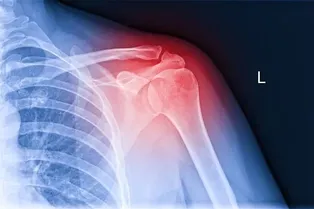 Ученые создали технологию для «печати» костных имплантов внутри тела Ученые создали технологию для «печати» костных имплантов внутри тела