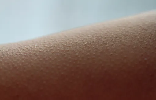 мурашки фото гусиная кожа человек