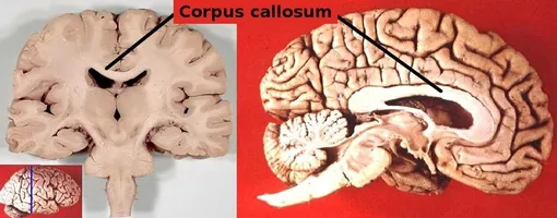 Мозолистое тело в разных разрезах. Мозолистое тело в разных разрезах.