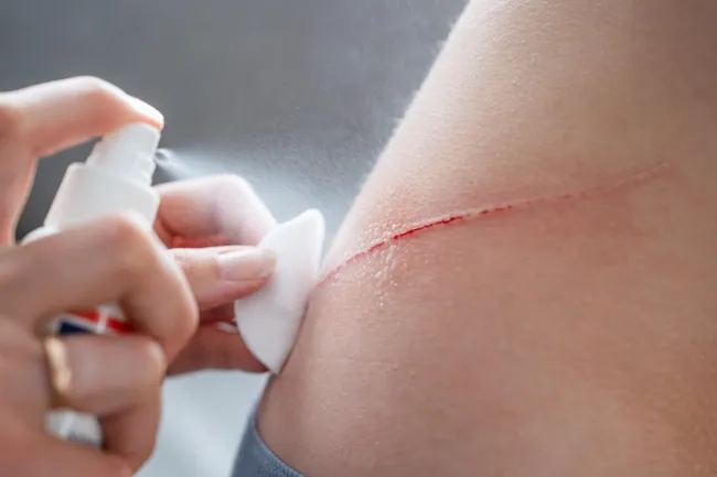 Ученые разработали спрей-порошок, чтобы мгновенно заживлять опасные раны