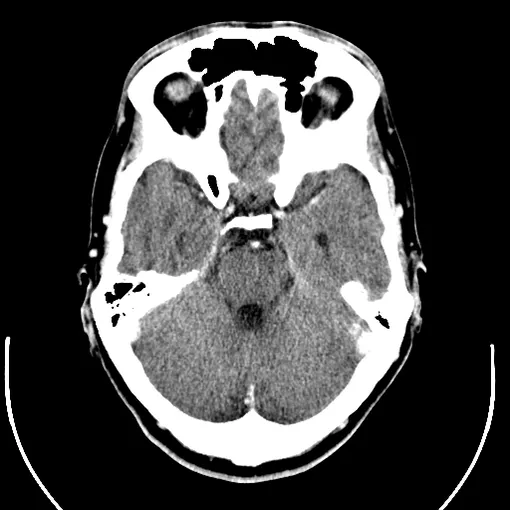 tomography scan of brain tomography scan of brain