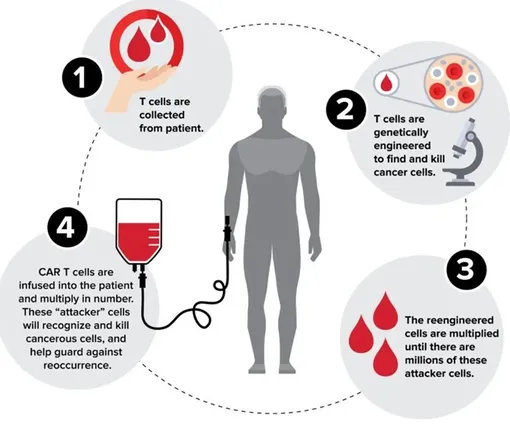 Цикл CAR-T терапии. 1— берется кровь пациента, 2— T-клетки модифицируются, 3—модифицированные Т-клетки размножаются, 4— Т-клетки готовые к борьбе с раком вводятся пациенту. Открытие позволяют весь этот цикл убрать и сразу модифицировать T-клетки прямо в организме.