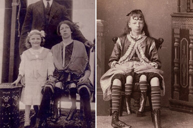Она жила с четырьмя ногами и двумя вагинами: история женщины-многоножки