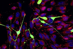 Раковые клетки высасывают энергию из нейронов при образовании метастазов Раковые клетки высасывают энергию из нейронов при образовании метастазов