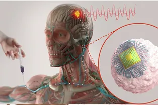Операция без операции: создано устройство, которое внедряется в мозг по кровотоку Операция без операции: создано устройство, которое внедряется в мозг по кровотоку
