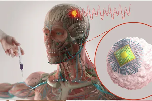 Операция без операции: создано устройство, которое внедряется в мозг по кровотоку Операция без операции: создано устройство, которое внедряется в мозг по кровотоку