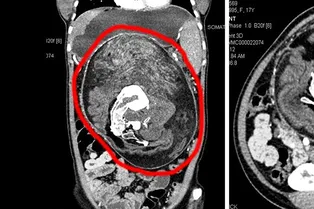Дикий медицинский случай: как в животе девушки нашли близнеца-паразита Дикий медицинский случай: как в животе девушки нашли близнеца-паразита