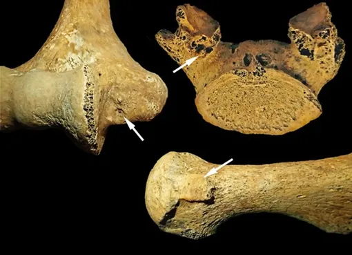 Различия в костях. Слева:восплаение плеча, связанное с многократными бросками. Справа вверху: поясничный позвонок с расхождением позвоночной дуги при подъеме тяжестей. Справа внизу: смещение пальцев ног при частом стоянии на коленях.