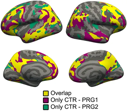 Желтым цветом обозначены области, затронутые как при первой, так и при второй беременности; зеленым — затронутые только при второй беременности, фиолетовым — только при первой,