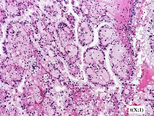 Транслокационная карцинома. Срез. Транслокационная карцинома. Срез.