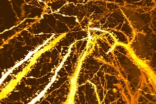 Нейробиологи обнаружили возможную причину шизофрении