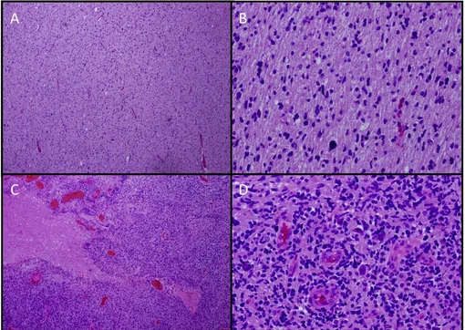 Окрашенные препараты опухоли DIPG при малом (A, C) и высоком (B, D) увеличении. Участки A и B классифицируются как низкодифференцированные, а C и D – как высокодифференцированные. Все образцы получены из одной и той же опухоли