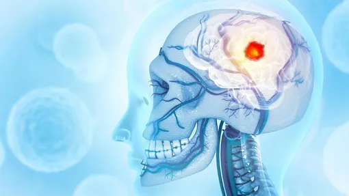 Глиобластома не только разрушает мозг, она перестраивает череп и иммунную систему.