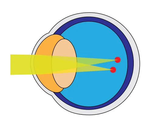 astigmatism scheme astigmatism scheme