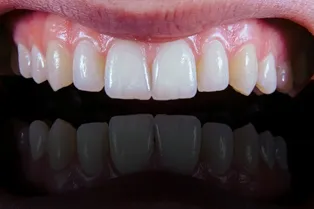 Ускоренная потеря зубов может предсказать болезни и раннюю смерть