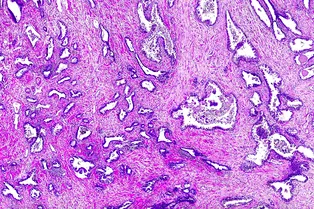 Найдены биомаркеры рака предстательной железы, которые улучшат диагностику и лечение болезни Найдены биомаркеры рака предстательной железы, которые улучшат диагностику и лечение болезни