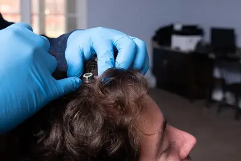 Пациент Neuralink, которому имплантировали устройство в мозг.