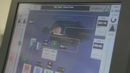 Искусственные легкие