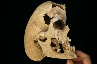 В Испании нашли скелет рыцаря с редким генетическим синдромом