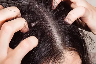 Грибок, неправильное питание и стресс: почему появляется перхоть на голове Грибок, неправильное питание и стресс: почему появляется перхоть на голове