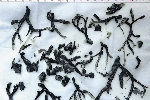 Бронхиальные слепки мужчины, извлеченные медицинскими работниками