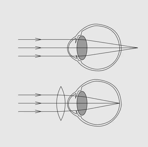 shortsightedness vision scheme shortsightedness vision scheme