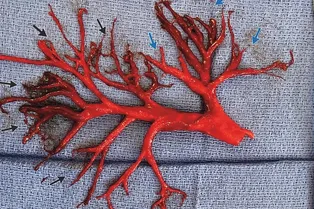 Плотный сгусток крови в форме бронхиального дерева: медицинская аномалия Плотный сгусток крови в форме бронхиального дерева: медицинская аномалия